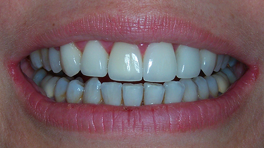 Discolored teeth before porcelain veneer treatment