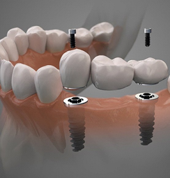 Digital illustration of a implant dental bridge in Tucson