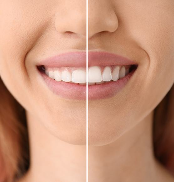 Before and after gum recontouring