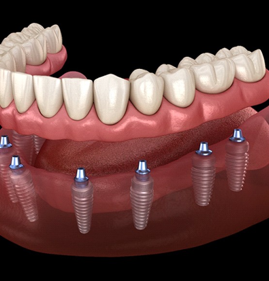 Lower implant denture in Tucson