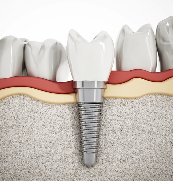 example of dental implant during post-op instructions in Tucson