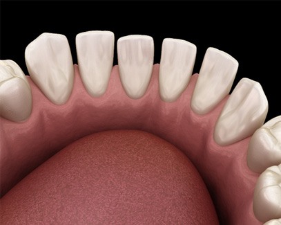 3D graphic of gaps between teeth