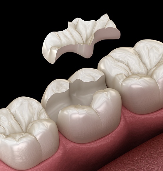 Animated dental inlay placement