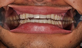 front of mouth with Cheek Retractors