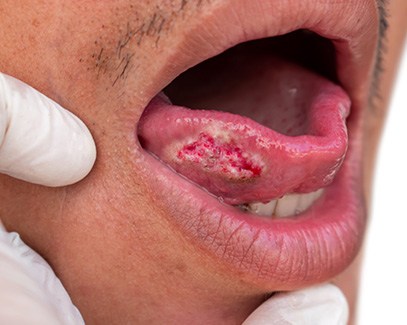 Oral cancer lesion