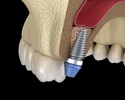 Diagram showing how dental implants in Tucson work