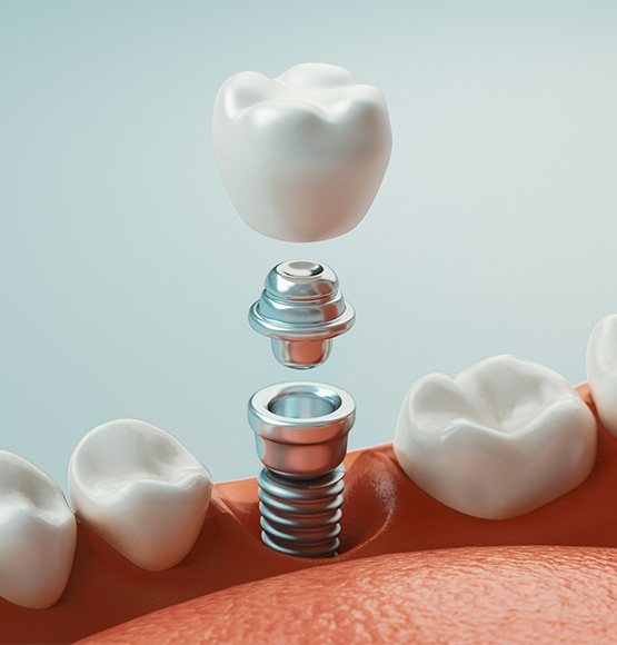 Animated dental implant supported dental crown placement