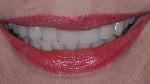 Flawless smile after porcelain veneer placement