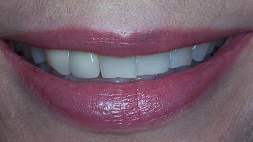 Worn teeth before porcelain veneers