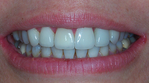 Perfected smile after porcelain veneer treatment