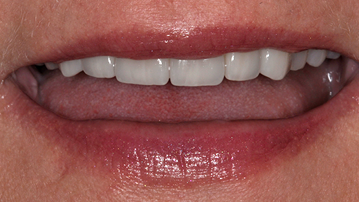 Beautiful smile after porcelain veneer treatment