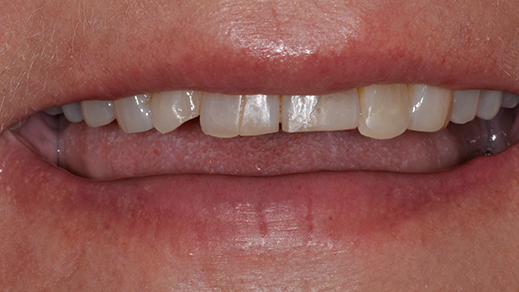 Severely worn and discolored teeth before porcelain veneer treatment