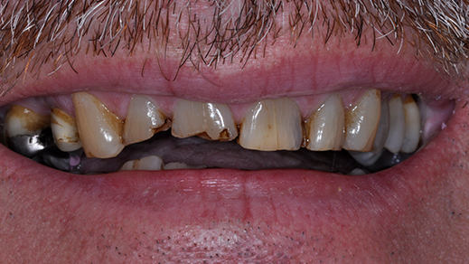 Severely decayed and damaged smile before dental restoration and porcelain veneers