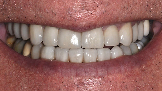 Healthy gorgeous smile after porcelain veneer treatment