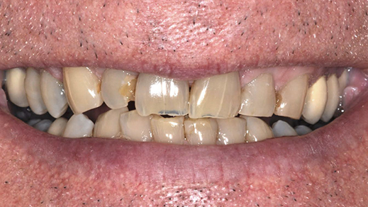 Worn and damaged teeth before porcelain veneer treatment
