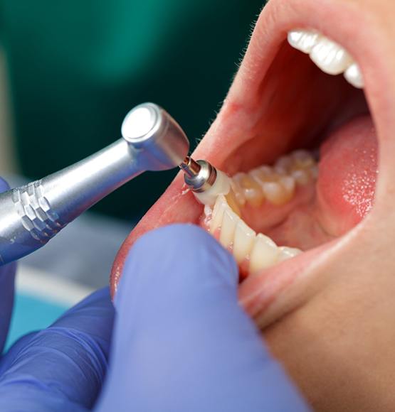 A patient having their teeth professionally cleaned