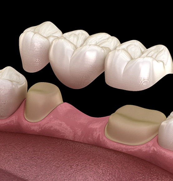 Digital illustration of dental bridge in Tucson