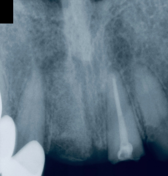 Dental X-ray after dentin grafting