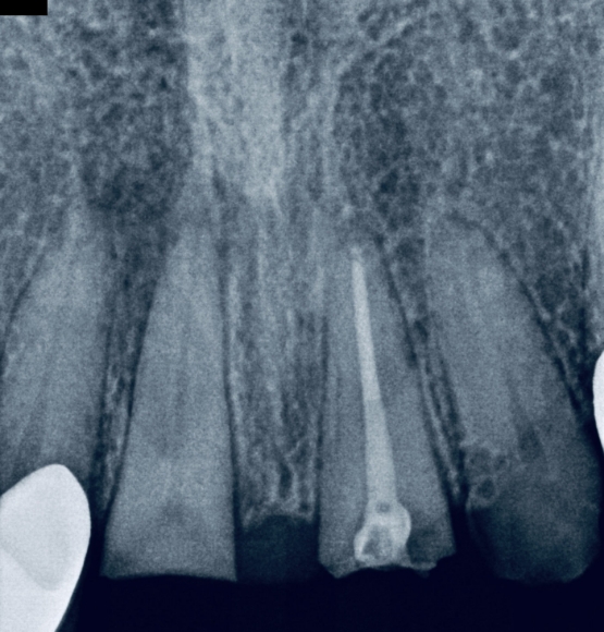 Dental X-ray before grafting