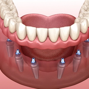 a computer illustration of implant dentures