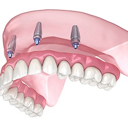 All-On-4 dentures