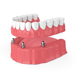 Dentures in Tucson, AZ being placed on dental implants