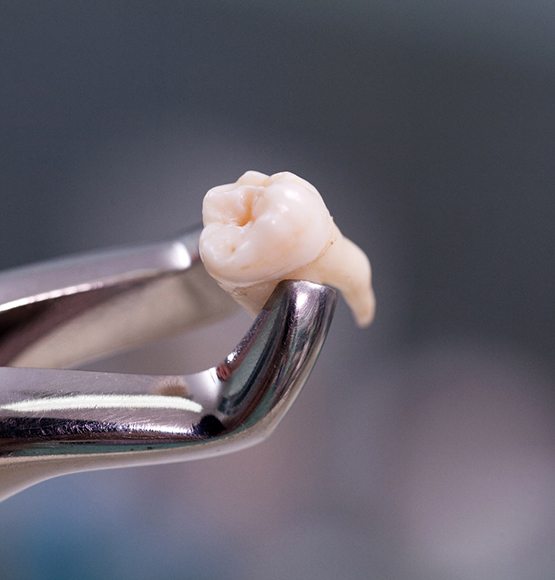 Extracted tooth being held by dental forceps