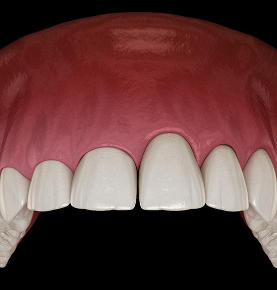 Digital illustration of uneven gumline