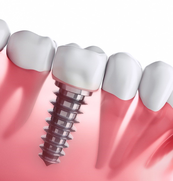 Digital diagram of dental implants in Tucson 