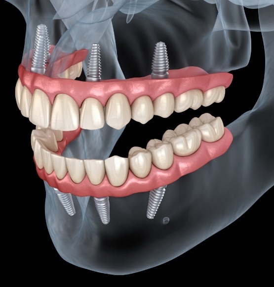 Animated smile dental implant supported upper and lower dentures