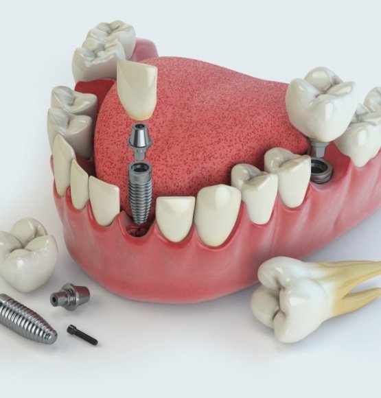 Animated smile dental implant supported replacement teeth being placed