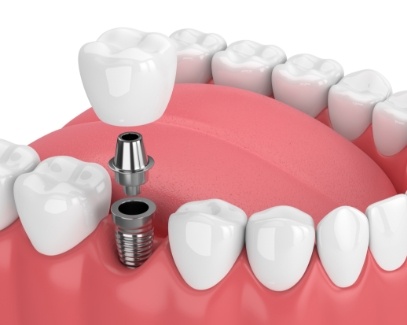 Animated dental implant supported dental crown placement