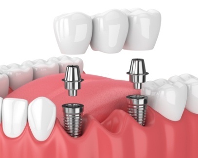 Animated dental implant supported fixed bridge placement