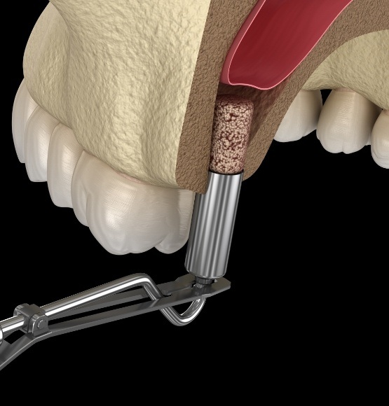 Animated smile during sinus lift treatment
