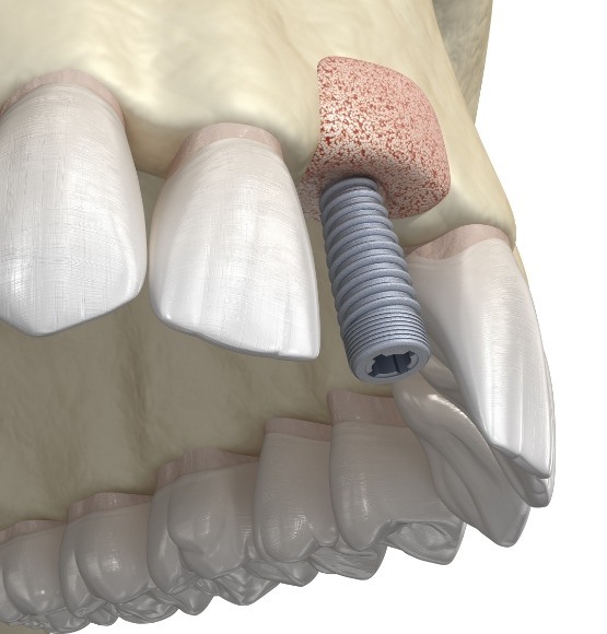 Animated smile with dental implant positioned into bone graft material