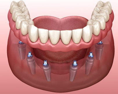 Illustration of implant dentures in Tucson