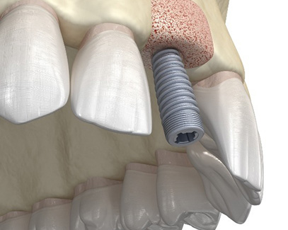 Animated smile with dental implant positioned into bone graft material