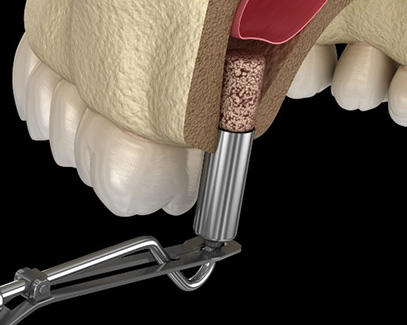 Animated smile during sinus lift treatment