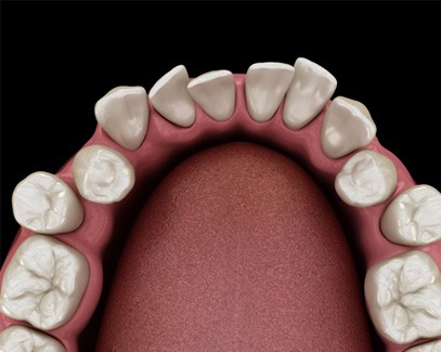 3D graphic of crowded teeth 