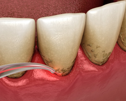 Illustration of dental laser being used in periodontal pocket