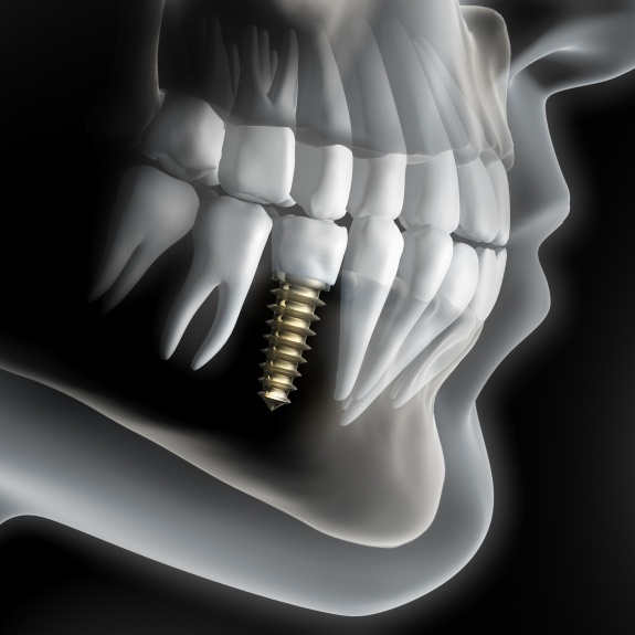 Illustration of a dental implant