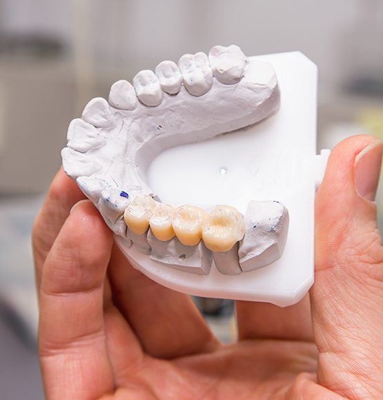 Model smile with dental bridge restoration