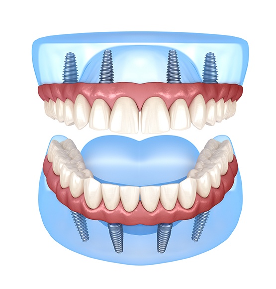 Animated dental implant supported dentures