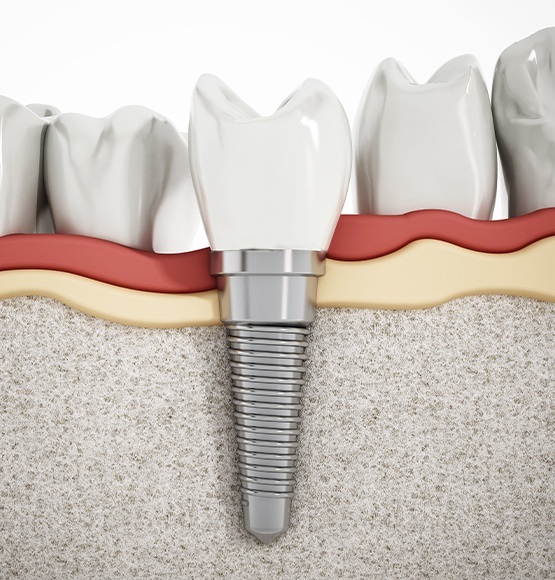 Animated smile with dental implant supported denture