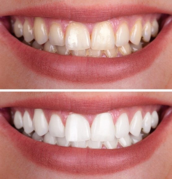 Closeup of before and after teeth whitening in Tucson