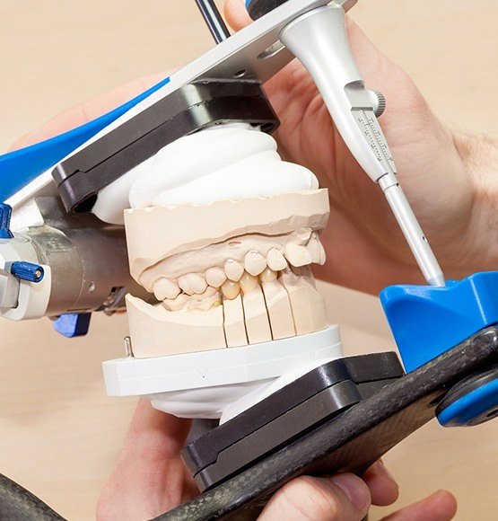 Model smile showing equilibration and occlusal adjustment