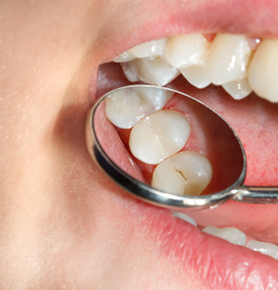 Close-up of white filling material in Tucson 