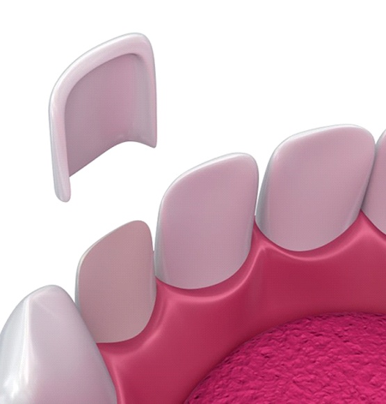 Diagram showing how veneers in Tucson are placed