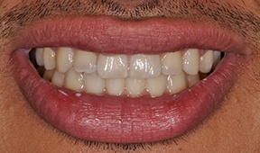 front of mouth
